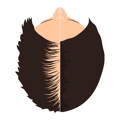 greffe de cheveux turquie